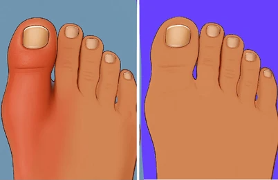 Comparison-of-a-swollen-injured-toe-and-a-healthy-foot