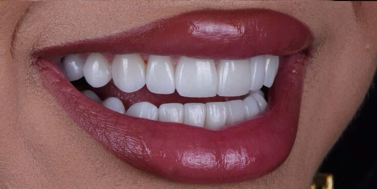 How Much Are Veneers? Your Complete 2025 Cost and Quality Guide