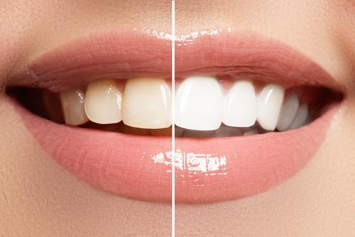how-to-whiten-teeth